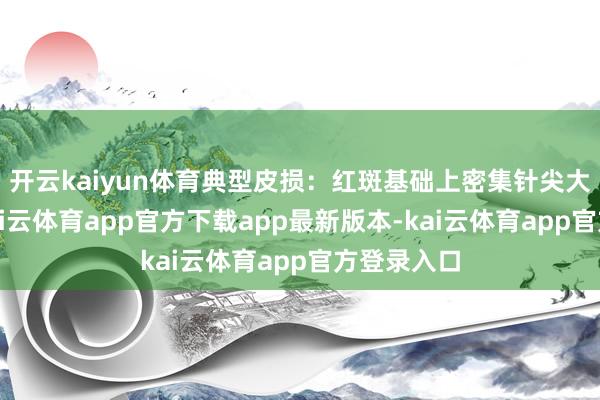 开云kaiyun体育典型皮损：红斑基础上密集针尖大小水疱-kai云体育app官方下载app最新版本-kai云体育app官方登录入口